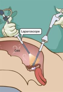 Fistula Surgery cost in Kanpur