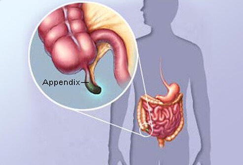 best appendix treatment in Kanpur