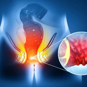 Inguinal hernia doctor in Kanpur 